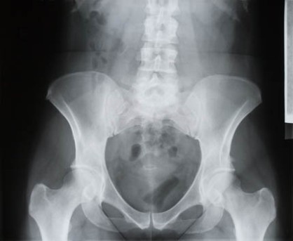 Pelvic Osteotomy by OrangeCountySurgeons.org  (2)